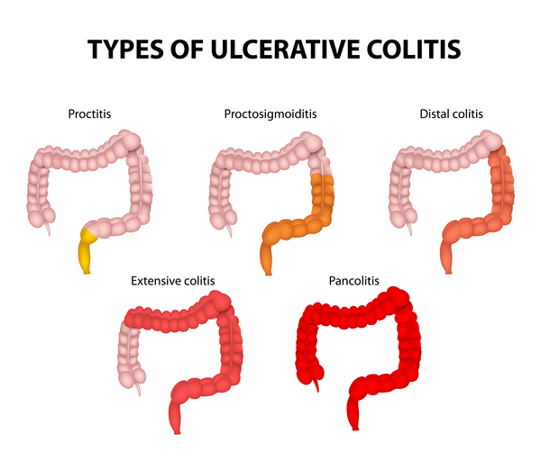 forms of ulcerative colitis, university bayreuth